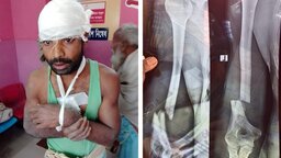নোয়াখালীতে কৃষকের হাত ভেঙে কুপিয়ে জখম